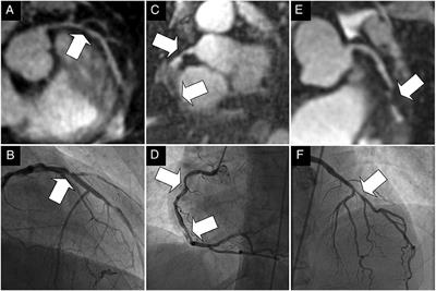 Coronary Magnetic Resonance Angiography in Chronic Coronary Syndromes